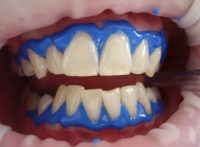 Oferta implanturi dentare