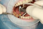 Implant dentar pret